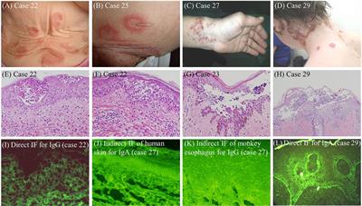 dermatosis ampollosa de diabetes
